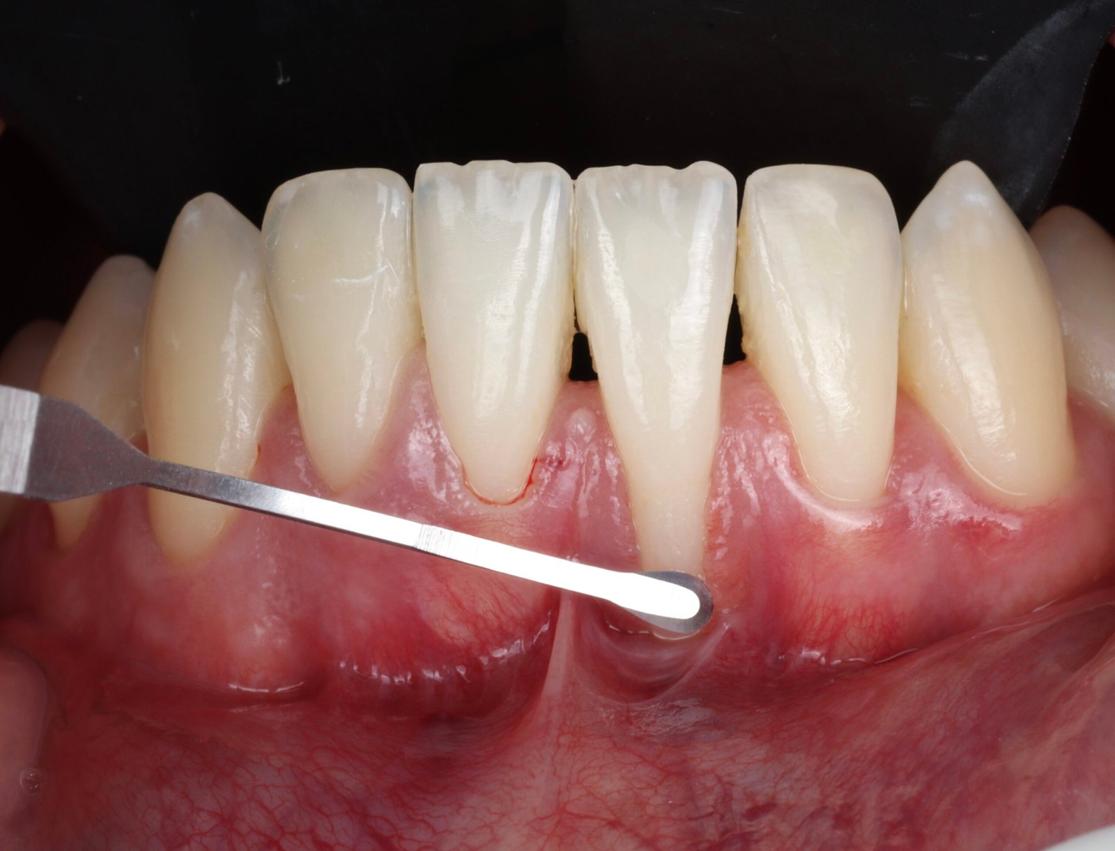 Clinical photograph of periodontal tissues and a surgical instrument