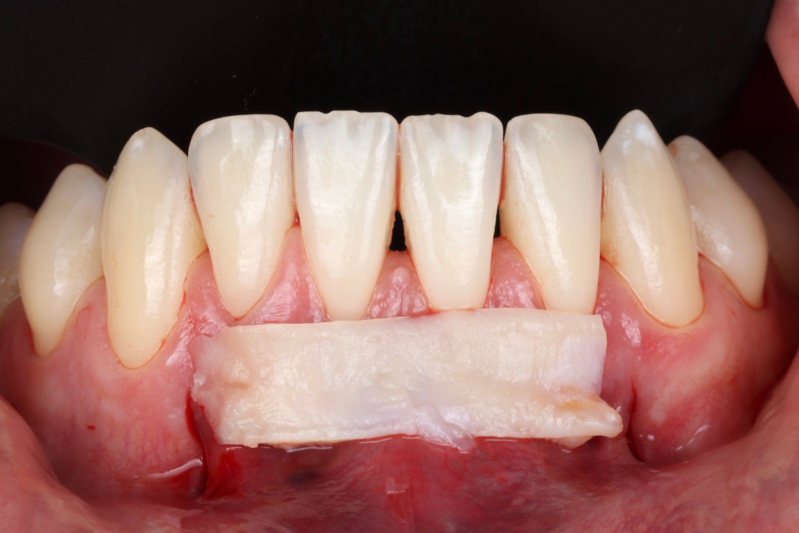 Clinical photograph of a soft tissue graft in the lower anterior region