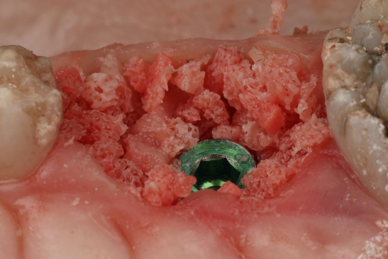 Close-up of an implant site and surrounding tissues