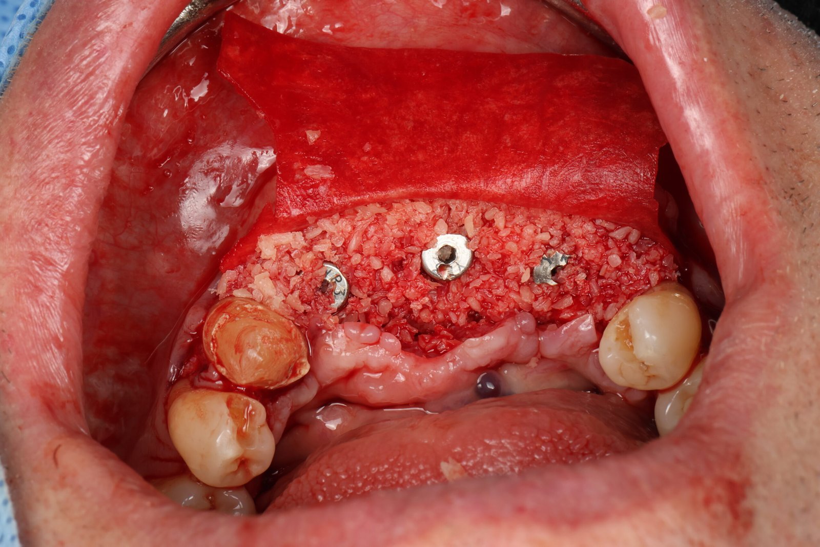 Clinical photograph of bone grafting around dental implants